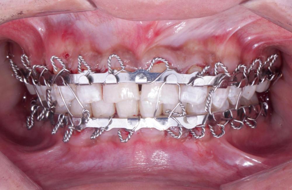 despues Corrección de fractura mandibular